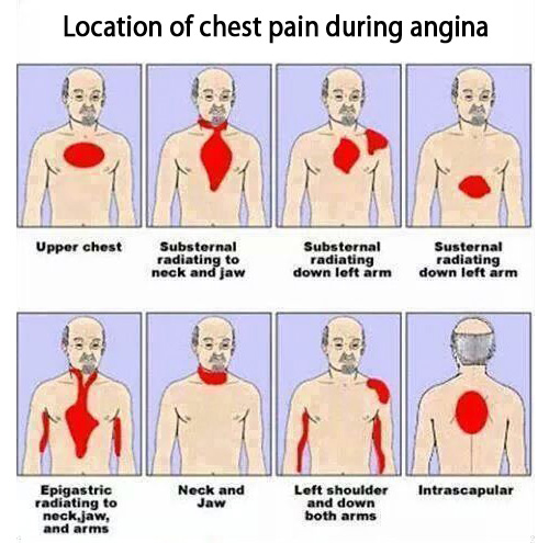 angina2