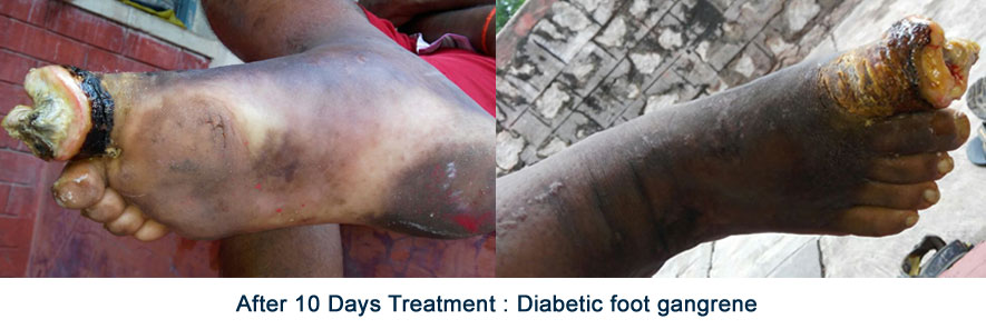 after-10-days-treatmen-diabetic-foot-gangrene