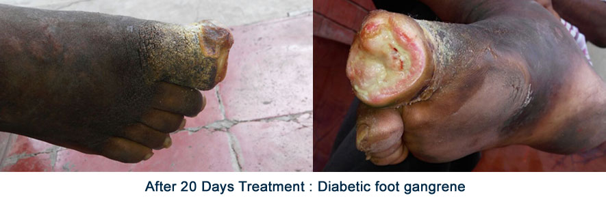 after-20-days-treatment-diabetic-foot-gangrene