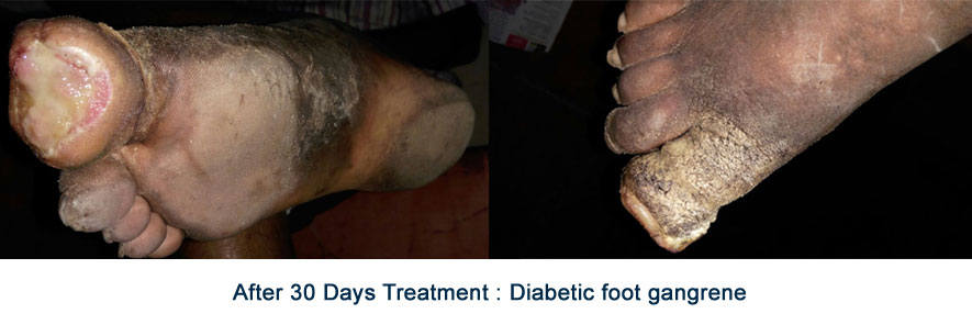 after-30-days-treatment-diabetic-foot-gangrene