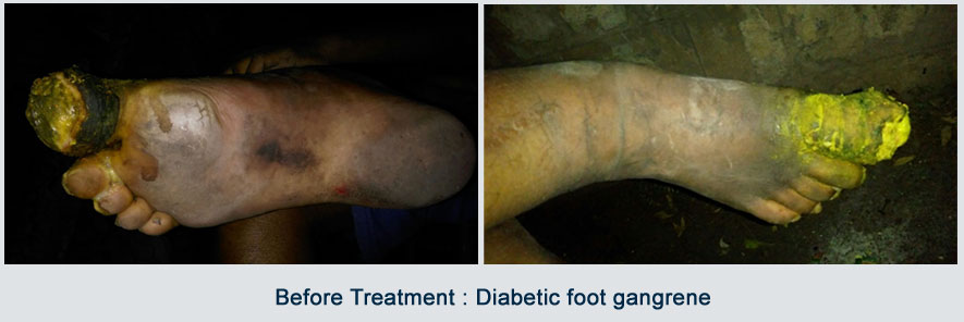 before-treatment-diabetic-foot-gangrene