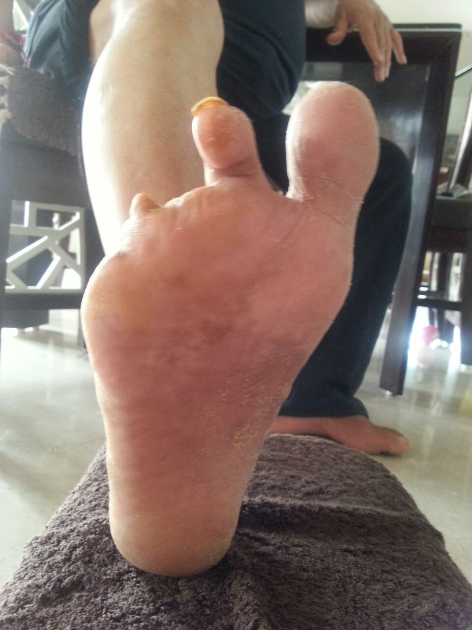 Diabetic foot Ulcer Gangrene Subhasbhai Vachhani Recovery Progress