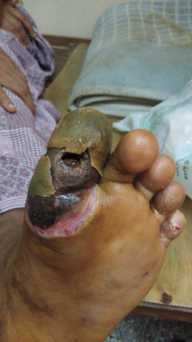 Diabetic Foot Ulcer / Gangrene Jaibunnisha – Welcome to Dr. Amina's