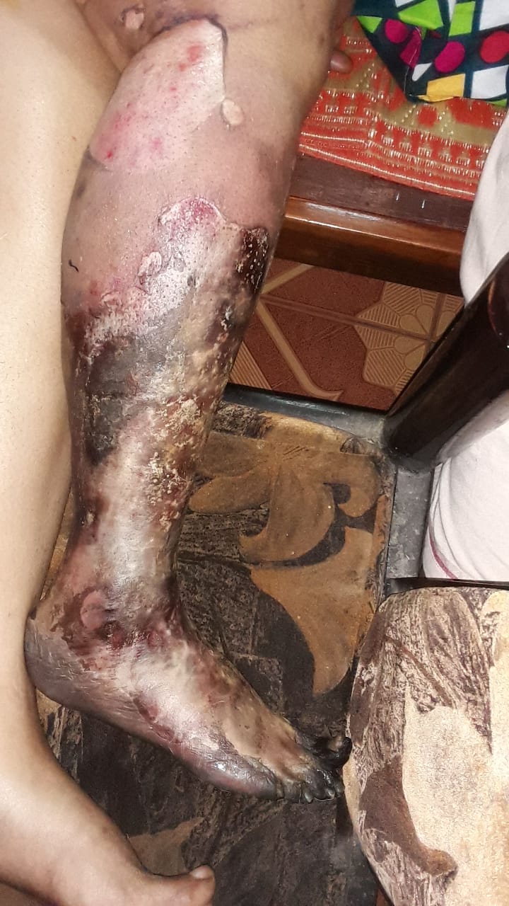 Susmitha – Diabetic foot dry gangrene – Welcome to Dr. Amina's Royal