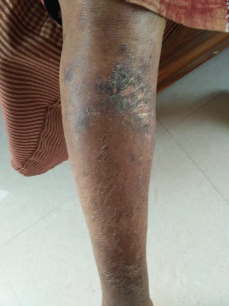 Diabetic foot Gangrene Mrs. Namita to Dr. Amina's Royal Ayurveda™