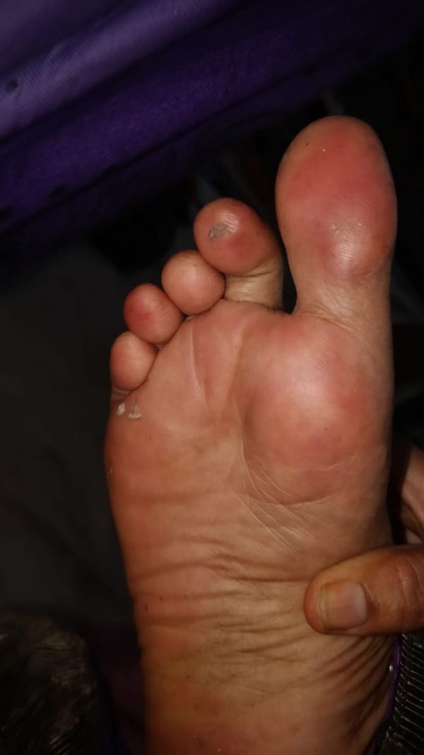 Diabetic foot Pre Gangrene Mrs Gaury to Dr. Amina's Royal