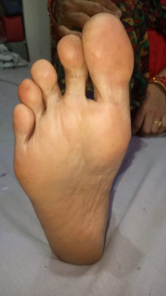 Diabetic foot Pre Gangrene Mrs Gaury to Dr. Amina's Royal